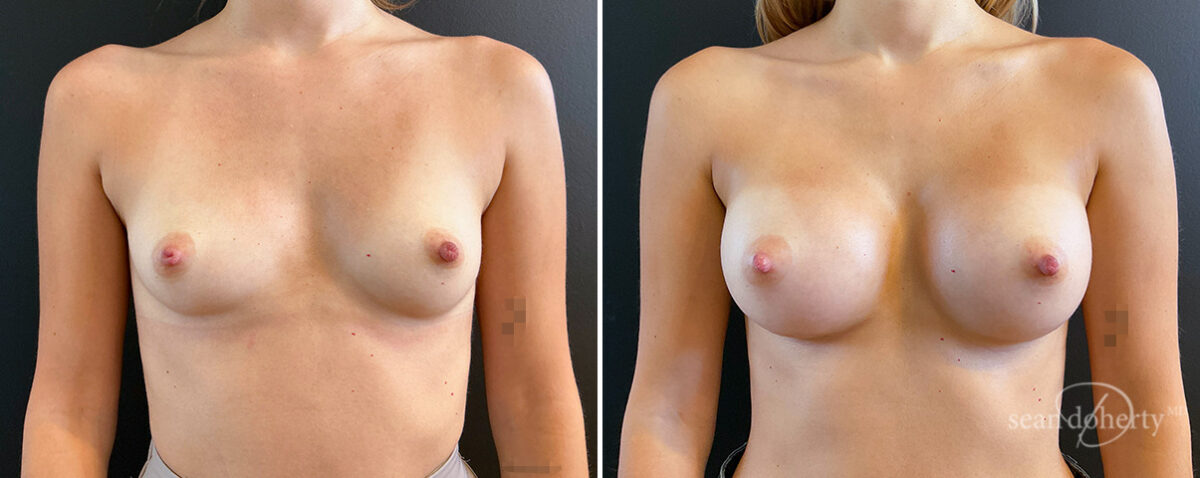 Breast Augmentation Before and After Photos in Boston, MA, Patient 16393