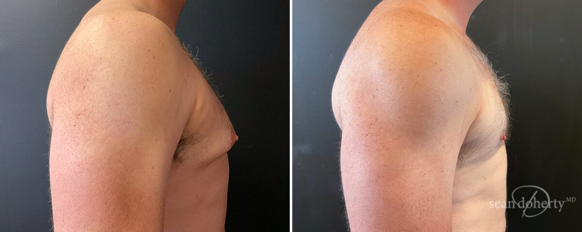 Gynecomastia Before and After Photos in Boston, MA, Patient 16408