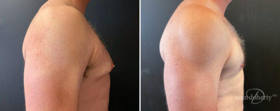 Gynecomastia Before and After Photos in Boston, MA, Patient 16408