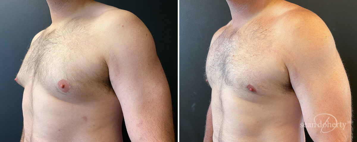 Gynecomastia Before and After Photos in Boston, MA, Patient 16408