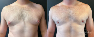 Gynecomastia Before and After Photos in Boston, MA, Patient 16408