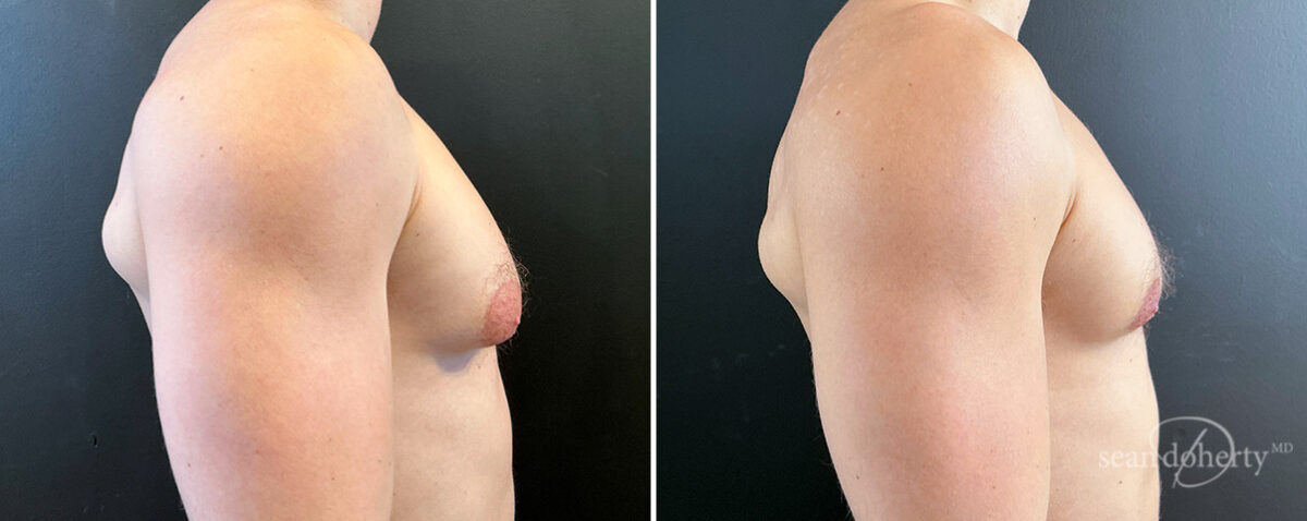Gynecomastia Before and After Photos in Boston, MA, Patient 16418