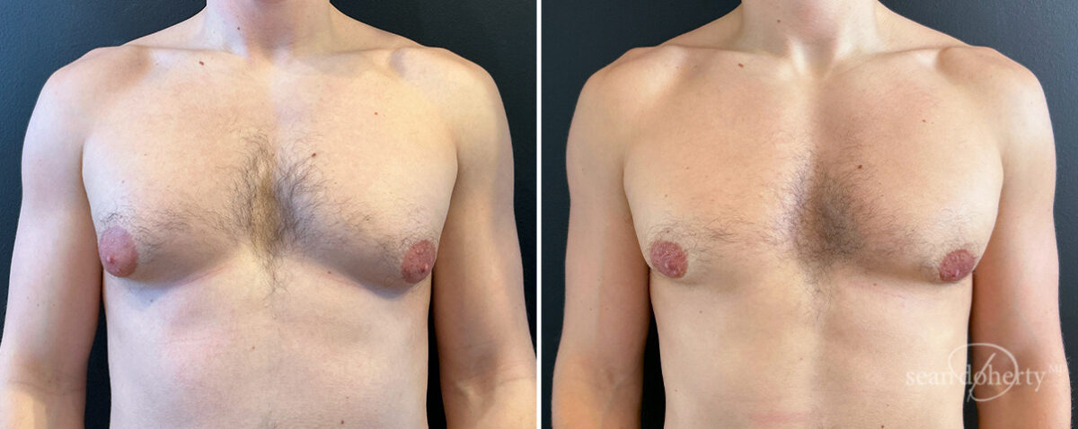 Gynecomastia Before and After Photos in Boston, MA, Patient 16418