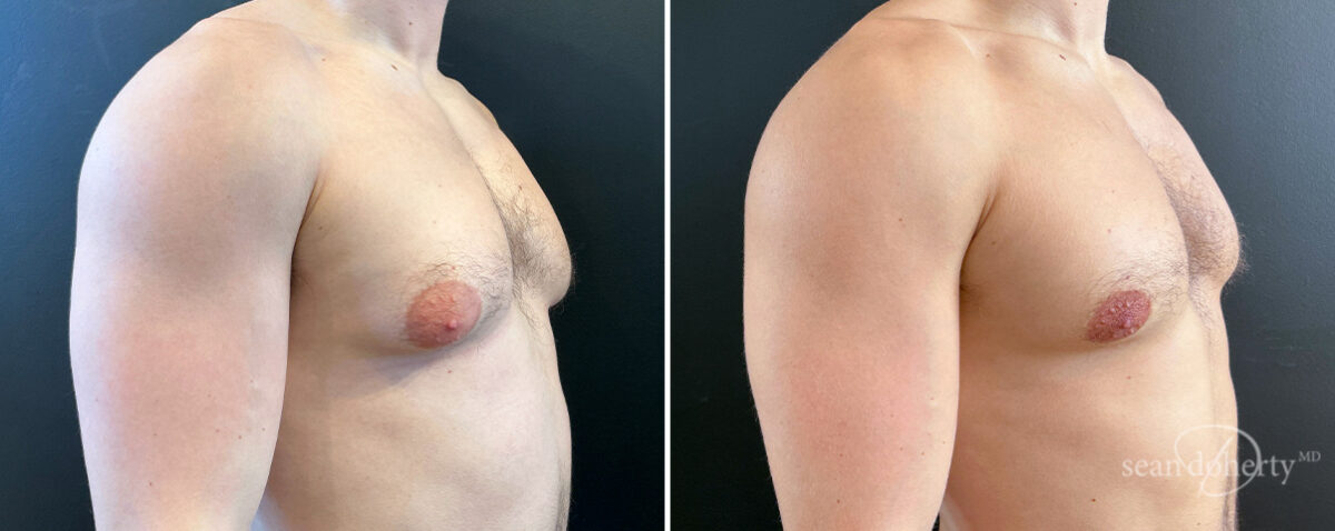 Gynecomastia Before and After Photos in Boston, MA, Patient 16418