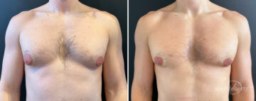 Gynecomastia Before and After Photos in Boston, MA, Patient 16418