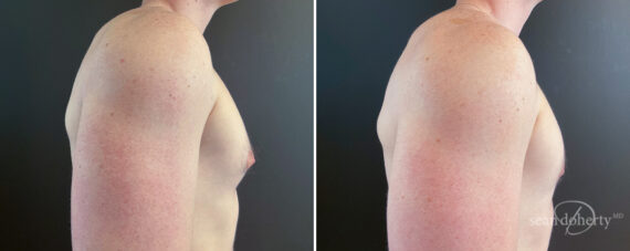 Gynecomastia Before and After Photos in Boston, MA, Patient 16428