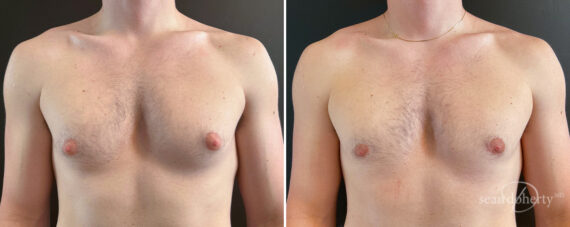 Gynecomastia Before and After Photos in Boston, MA, Patient 16428