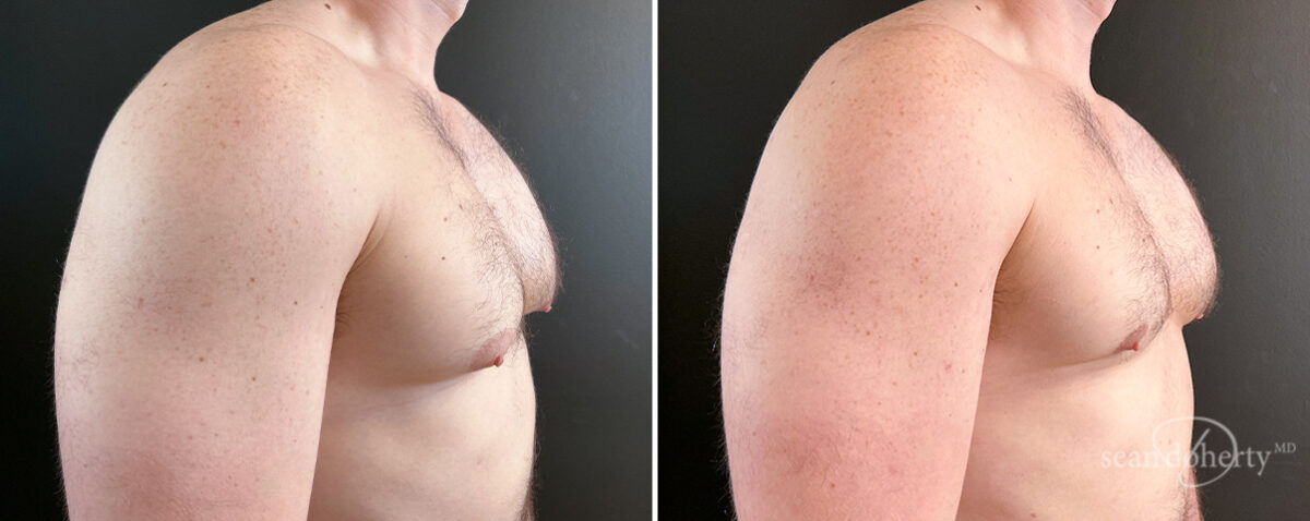 Gynecomastia Before and After Photos in Boston, MA, Patient 16438