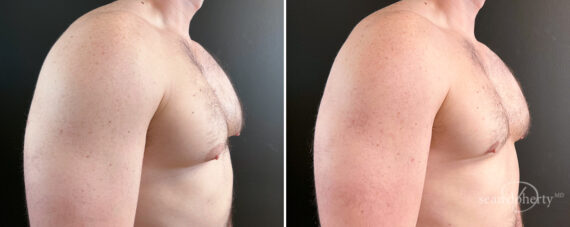 Gynecomastia Before and After Photos in Boston, MA, Patient 16438