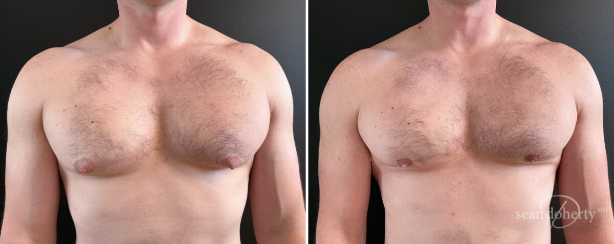Gynecomastia Before and After Photos in Boston, MA, Patient 16438