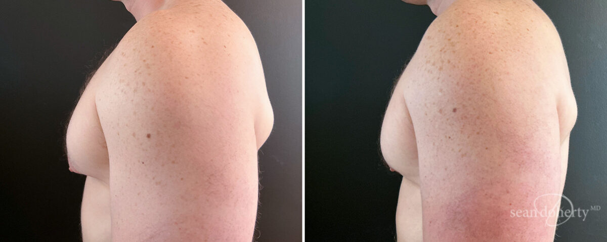 Gynecomastia Before and After Photos in Boston, MA, Patient 16438