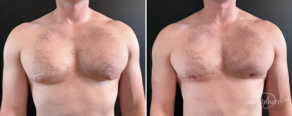 Gynecomastia Before and After Photos in Boston, MA, Patient 16438