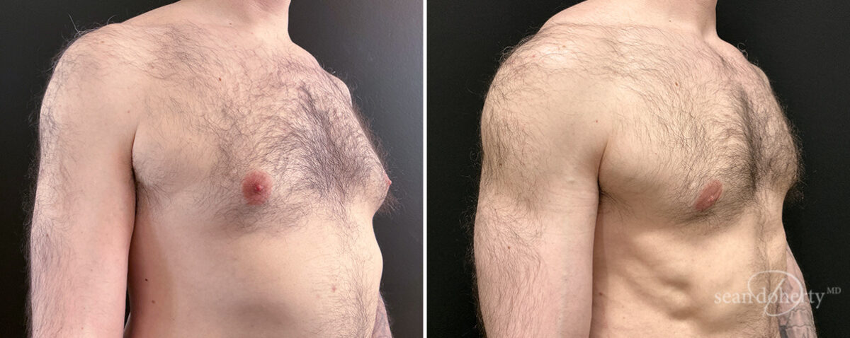 Gynecomastia Before and After Photos in Boston, MA, Patient 16448
