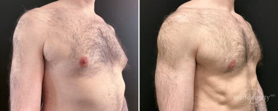 Gynecomastia Before and After Photos in Boston, MA, Patient 16448