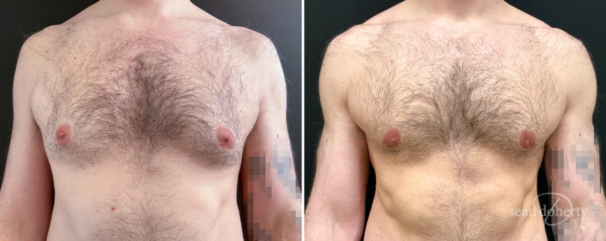 Gynecomastia Before and After Photos in Boston, MA, Patient 16448