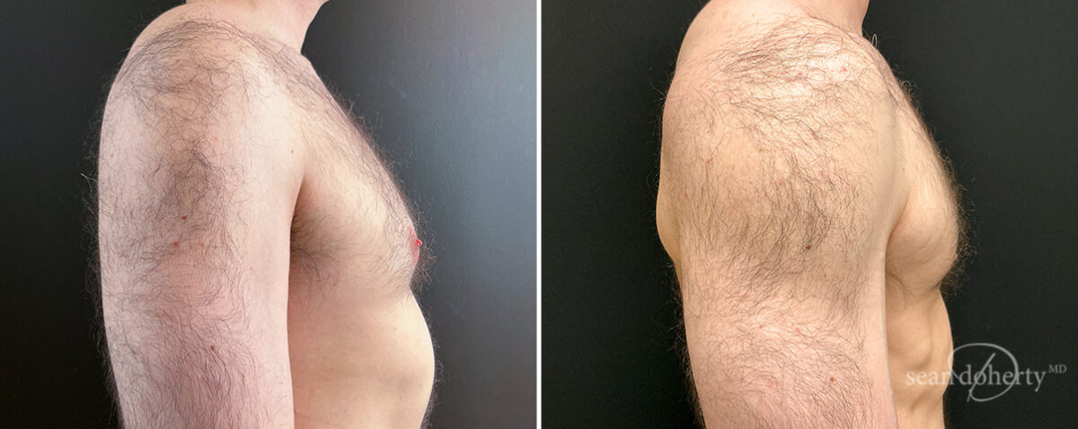 Gynecomastia Before and After Photos in Boston, MA, Patient 16448