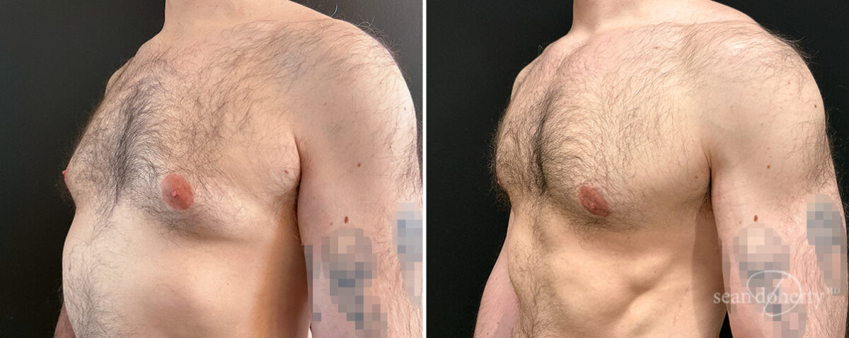Gynecomastia Before and After Photos in Boston, MA, Patient 16448