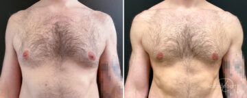 Gynecomastia Before and After Photos in Boston, MA, Patient 16448