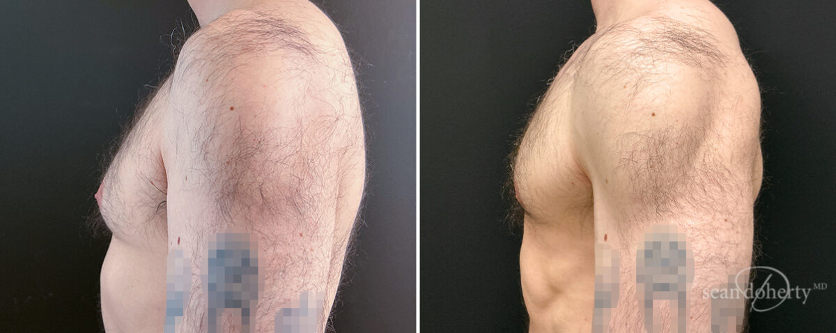 Gynecomastia Before and After Photos in Boston, MA, Patient 16448
