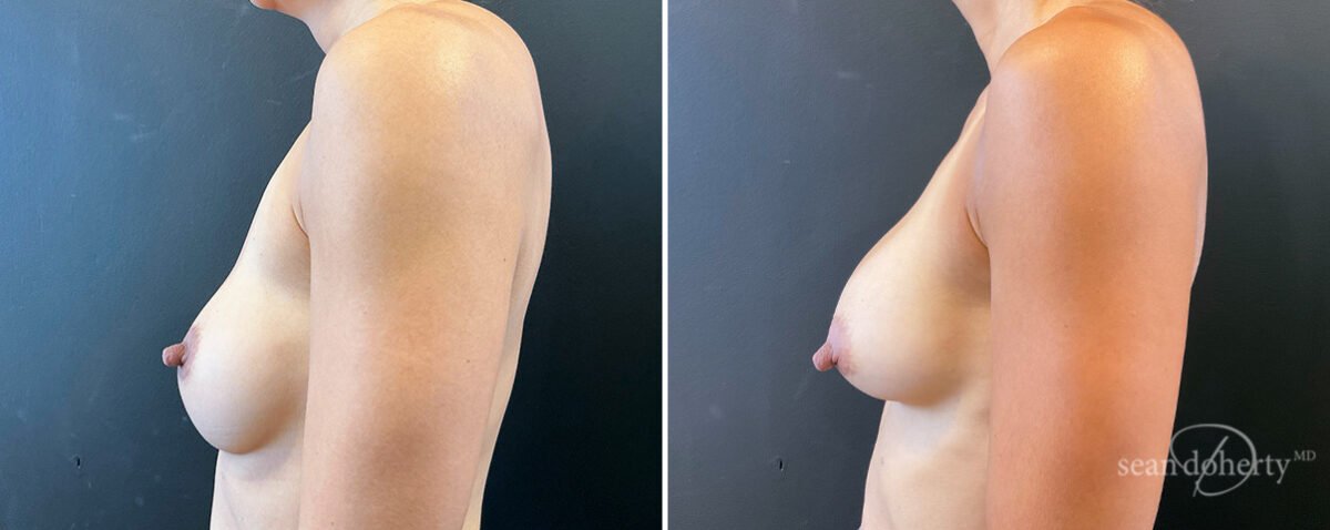 Breast Implant Exchange Before and After Photos in Boston, MA, Patient 16464