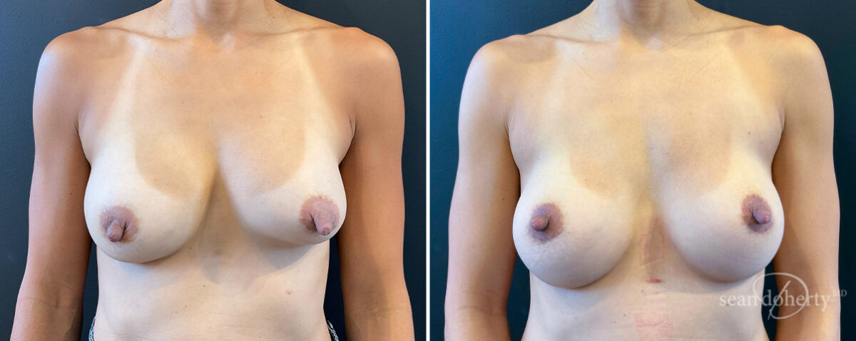 Breast Implant Exchange Before and After Photos in Boston, MA, Patient 16464