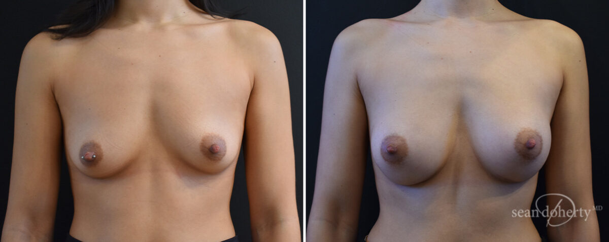 Breast Augmentation Before and After Photos in Boston, MA, Patient 16474