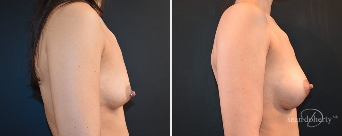 Breast Augmentation Before and After Photos in Boston, MA, Patient 16474