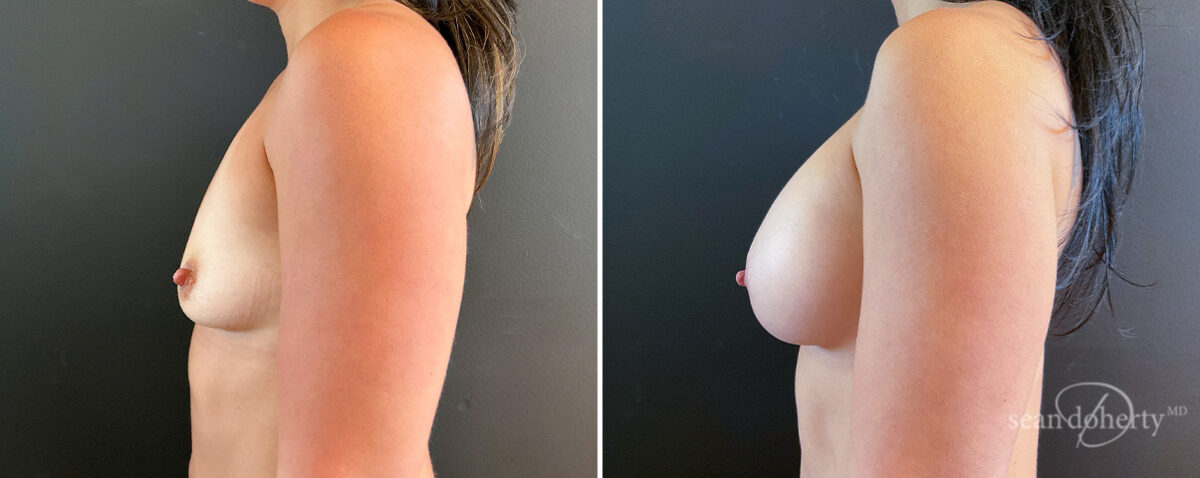 Breast Augmentation Before and After Photos in Boston, MA, Patient 16484
