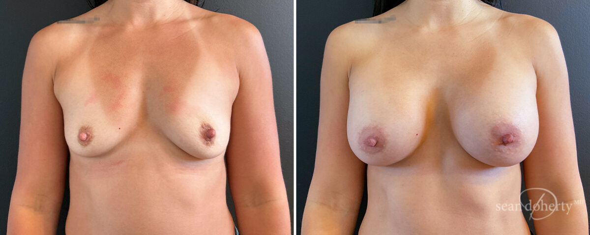 Breast Augmentation Before and After Photos in Boston, MA, Patient 16484