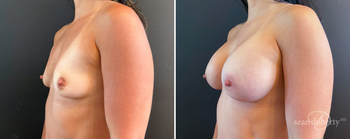 Breast Augmentation Before and After Photos in Boston, MA, Patient 16484