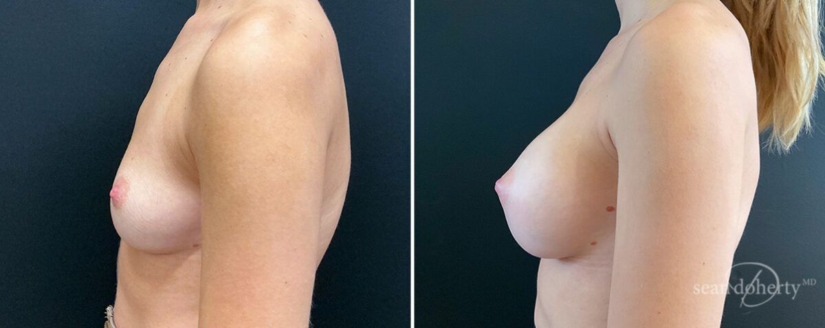 Breast Augmentation Before and After Photos in Boston, MA, Patient 16494