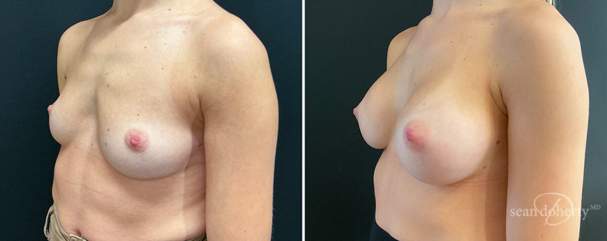 Breast Augmentation Before and After Photos in Boston, MA, Patient 16494