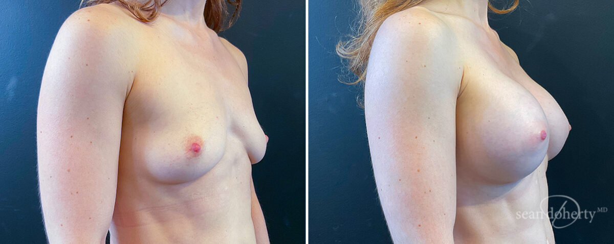 Breast Augmentation Before and After Photos in Boston, MA, Patient 16505