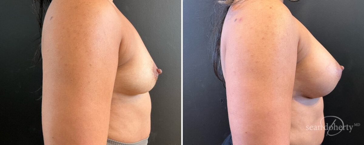 Breast Augmentation Before and After Photos in Boston, MA, Patient 16515