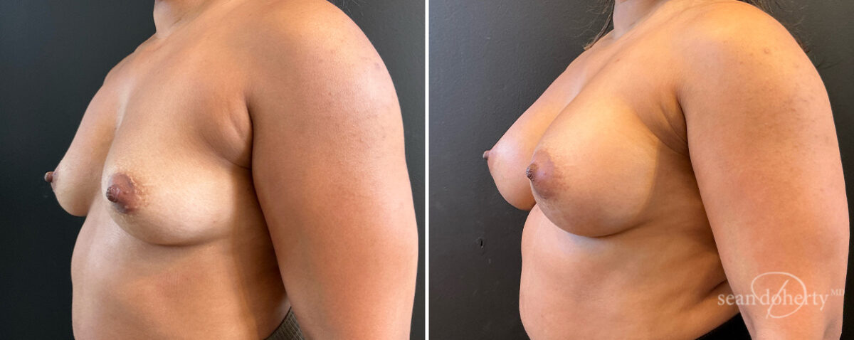 Breast Augmentation Before and After Photos in Boston, MA, Patient 16515
