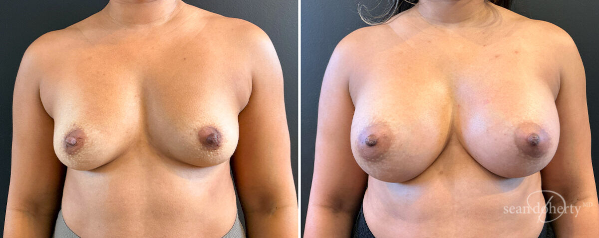 Breast Augmentation Before and After Photos in Boston, MA, Patient 16515