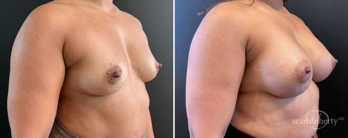 Breast Augmentation Before and After Photos in Boston, MA, Patient 16515