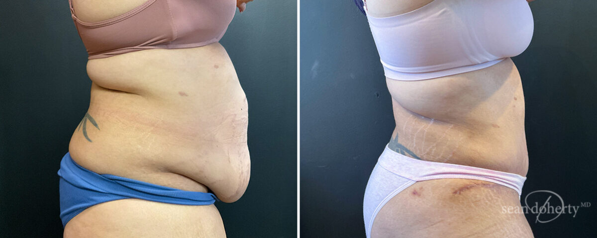 Liposuction Before and After Photos in Boston, MA, Patient 16567
