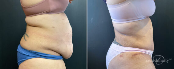 Liposuction Before and After Photos in Boston, MA, Patient 16567