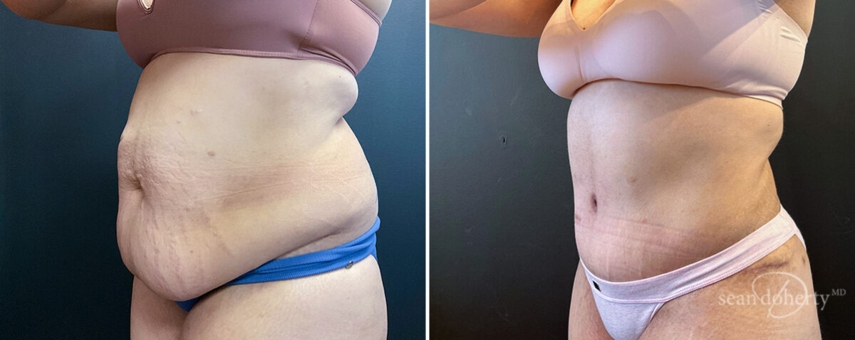 Liposuction Before and After Photos in Boston, MA, Patient 16567