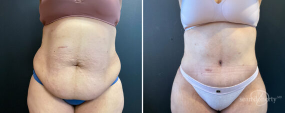Liposuction Before and After Photos in Boston, MA, Patient 16567
