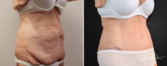 Tummy Tuck Before and After Photos in Boston, MA, Patient 16577