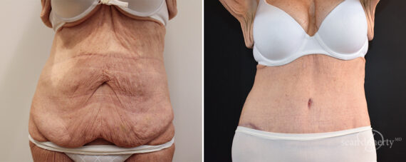Tummy Tuck Before and After Photos in Boston, MA, Patient 16577