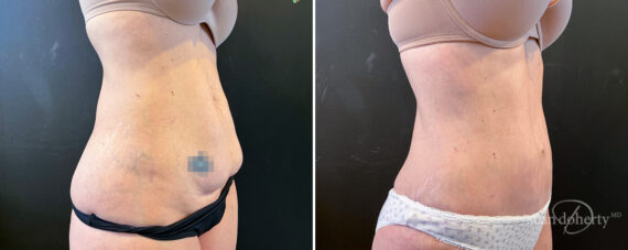 Tummy Tuck Before and After Photos in Boston, MA, Patient 16590