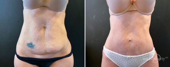 Tummy Tuck Before and After Photos in Boston, MA, Patient 16590