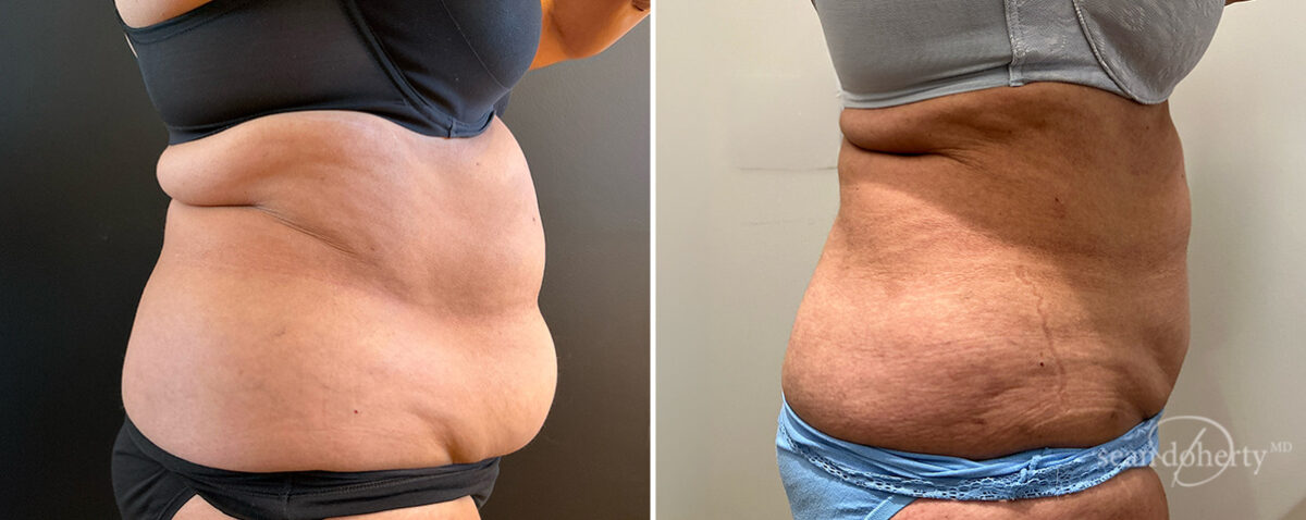 Liposuction Before and After Photos in Boston, MA, Patient 16615