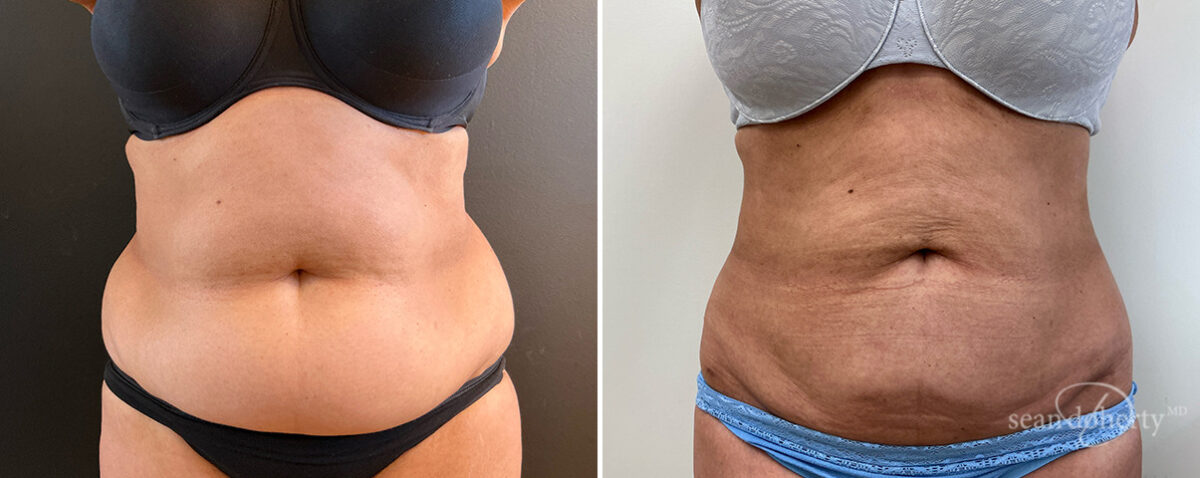 Liposuction Before and After Photos in Boston, MA, Patient 16615