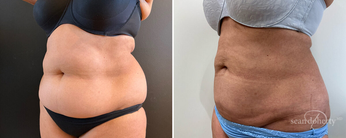 Liposuction Before and After Photos in Boston, MA, Patient 16615