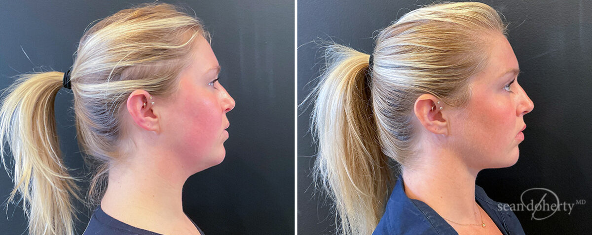 Liposuction Before and After Photos in Boston, MA, Patient 16625