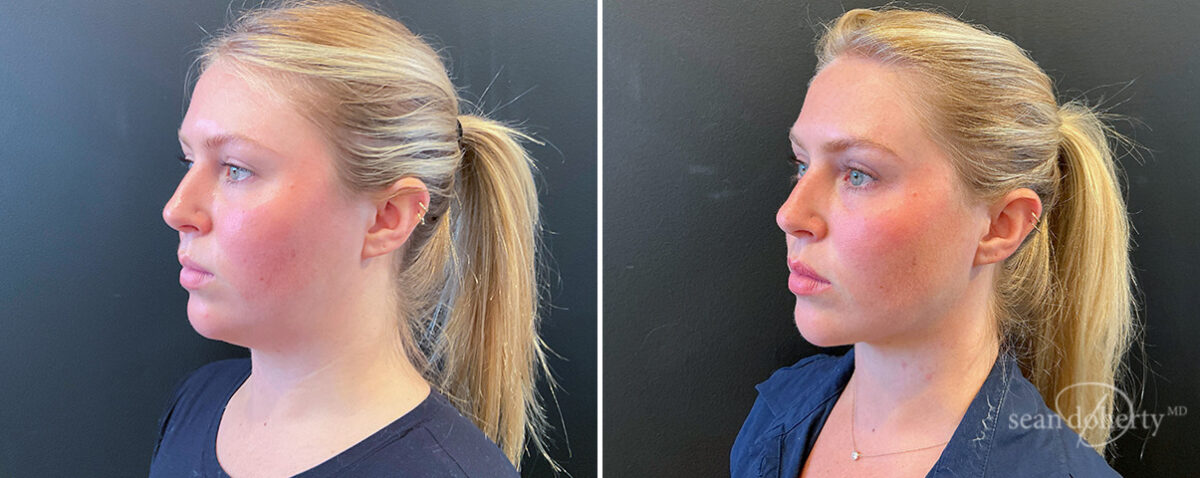 Liposuction Before and After Photos in Boston, MA, Patient 16625